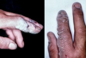 Quemaduras con ácido fluorhídrico
